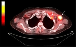PET/CT dermatomyositt og kreft
