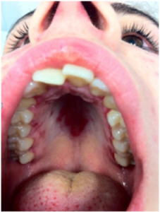 SLE med munnsår